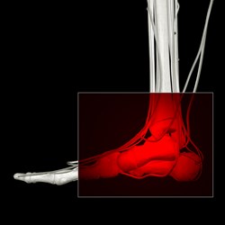 Image for Charcot Foot